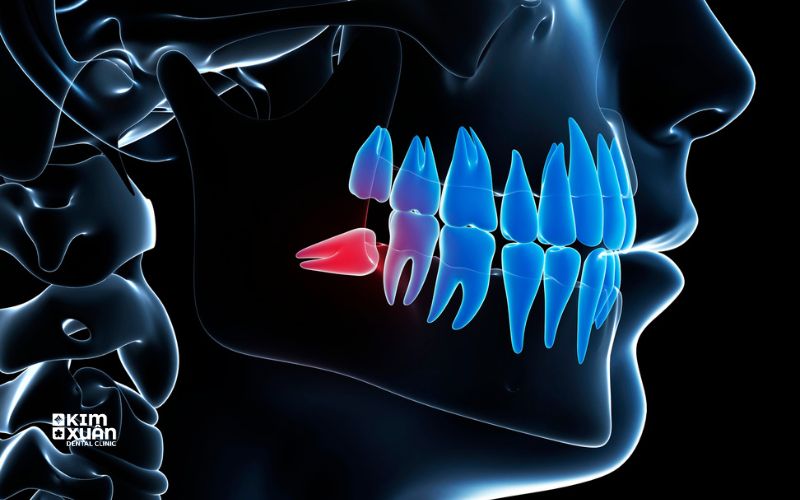 Răng Khôn Mọc Ngầm Nằm Nghiêng