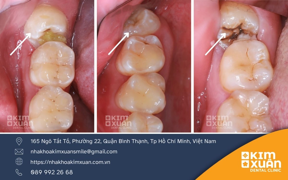 Mọc Răng Khôn Ở Vị Trí Nào