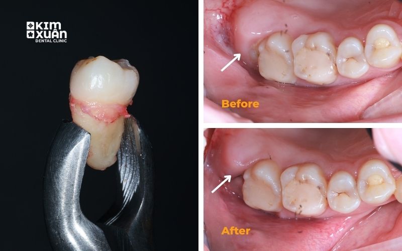 Răng Khôn Răng Sô 8