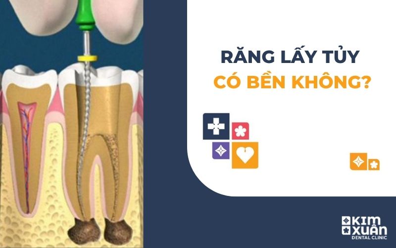 Răng Lấy Tủy Có Bền Không