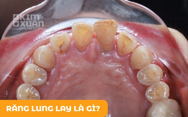 Răng Lung Lay