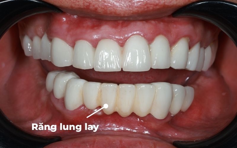 Răng Lung Lay Có Giữ Được Không