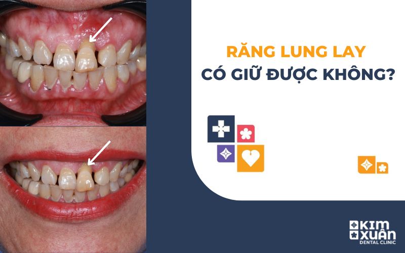 Răng Lung Lay Có Giữ Được Không