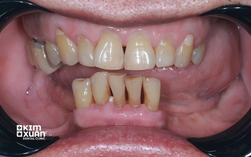 Răng Lung Lay Do Bị Viêm Nha Chu