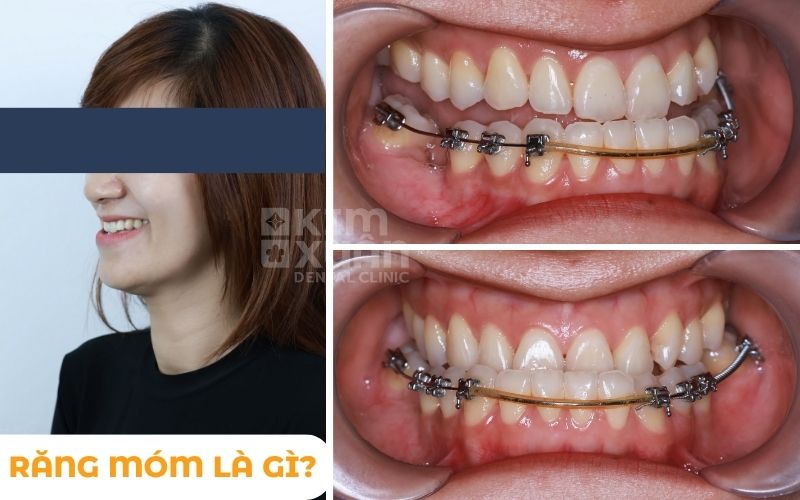 Răng Móm Là Gì Niềng Mất Bao Lâu
