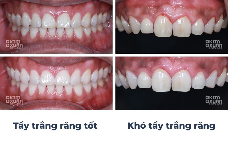Răng Ố Vàng Có Tẩy Trắng Răng Được Không