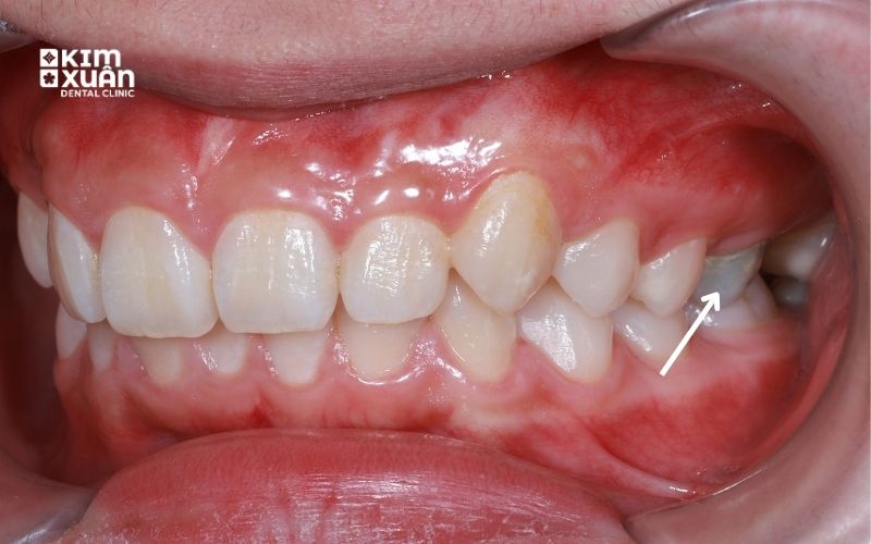 Răng Sâu Có Nên Nhổ Không