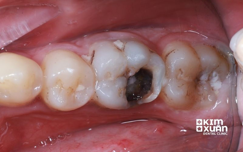 Răng Sâu Vào Tủy Là Gì