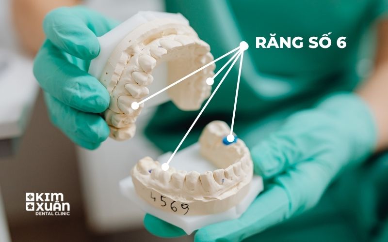 Răng Số 6