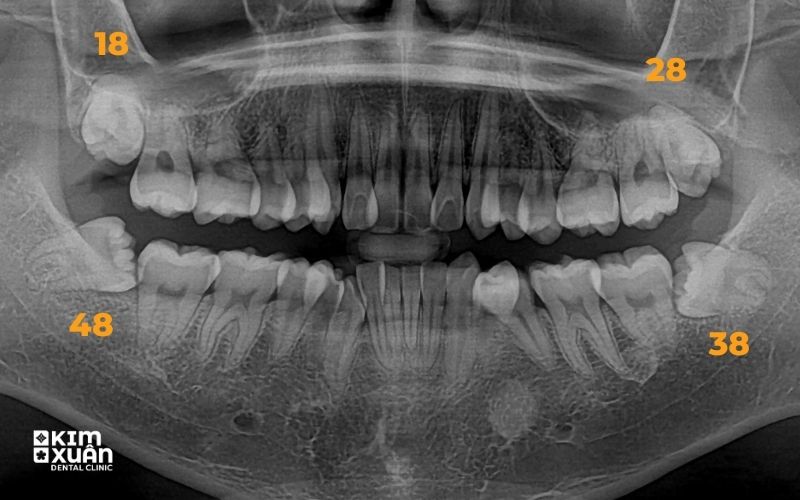 Răng Số 8 Bị Sâu