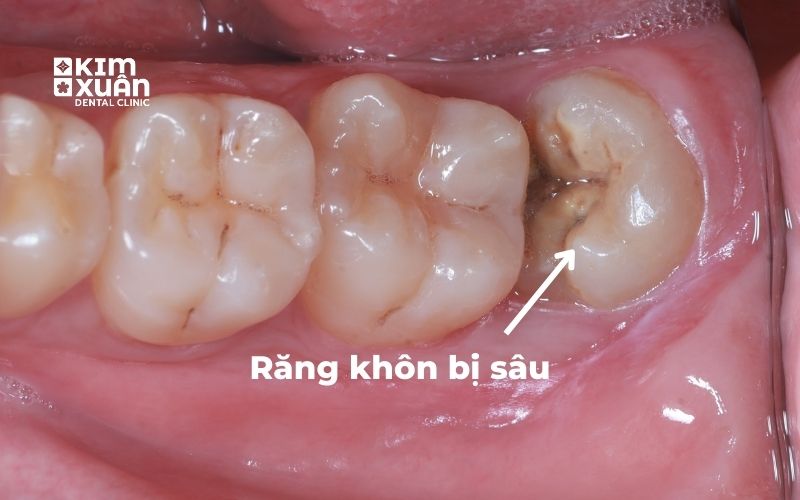 Răng Số 8 Bị Sâu