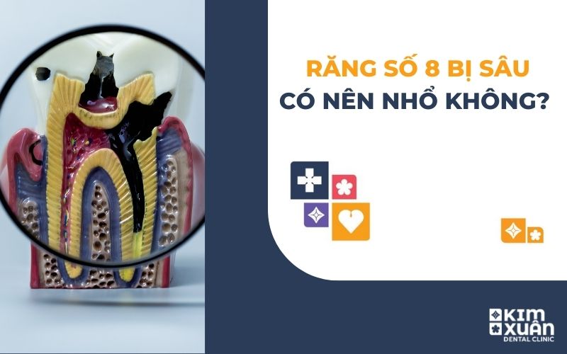 Răng Số 8 Bị Sâu Có Nên Nhổ Không