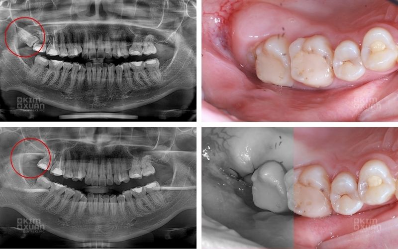 Răng Số 8 bị Sâu Có Nên Nhổ Không