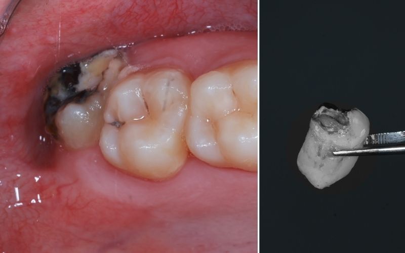 Răng Số 8 Bị Sâu