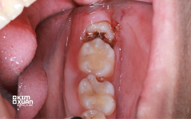 Răng Số 8 Mọc Ngầm