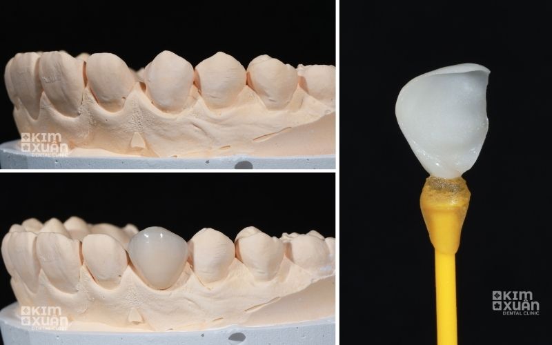 Răng Sứ Emax Có Mấy Loại