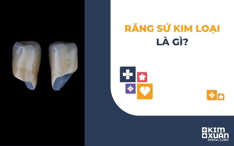 Răng Sứ Kim Loại