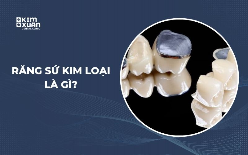 Răng Sứ Kim Loại
