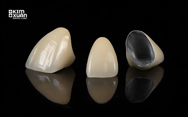Răng Sứ Kim Loại Có Tốt Không