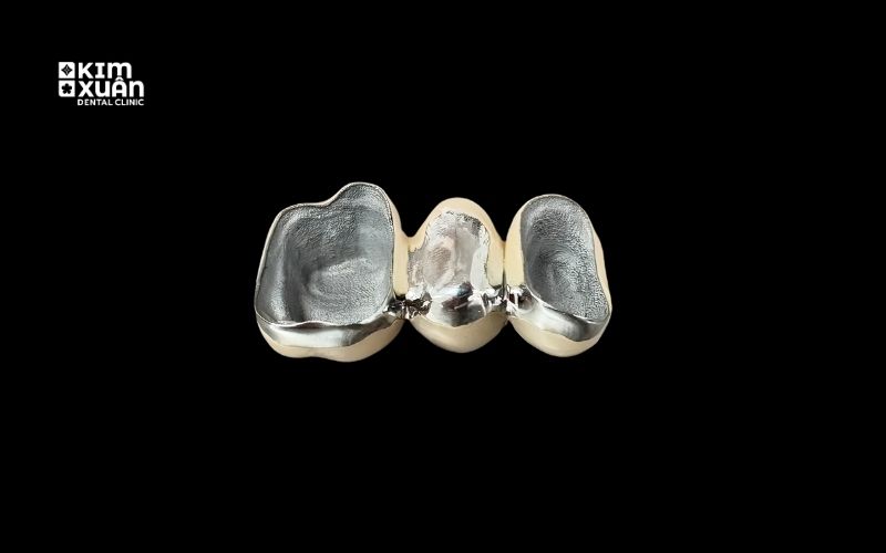 Răng Sứ Kim Loại Giá bao Nhiêu