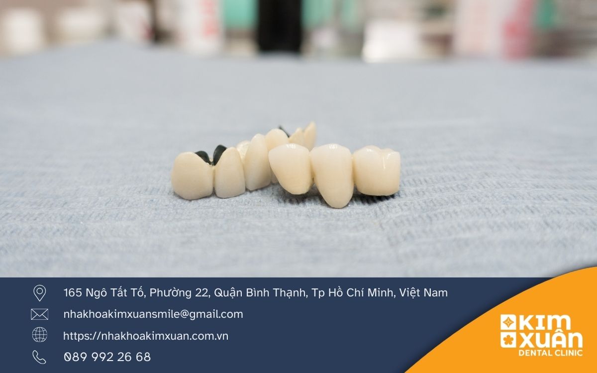 Răng Sứ Kim Loại Giá Bao Nhiêu