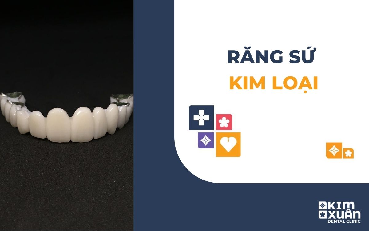 Răng Sứ Kim Loại