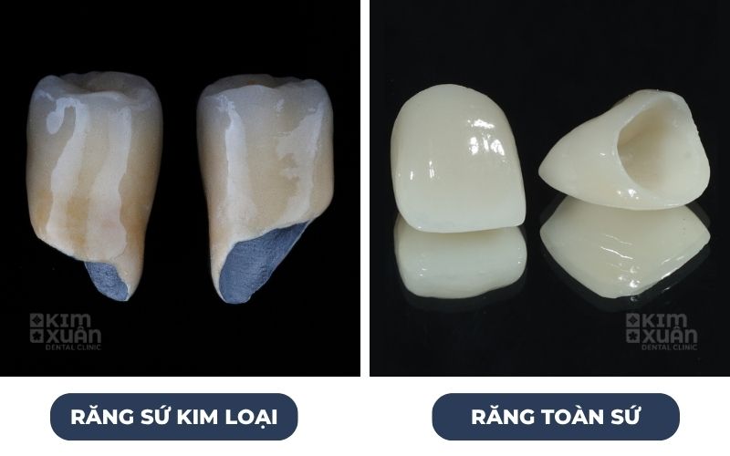 Răng Sứ Kim Loại Và Răng Sứ Toàn Sứ