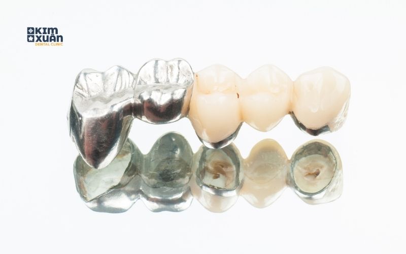 Răng Sứ Titan