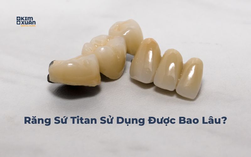 Răng sứ titan có bền không