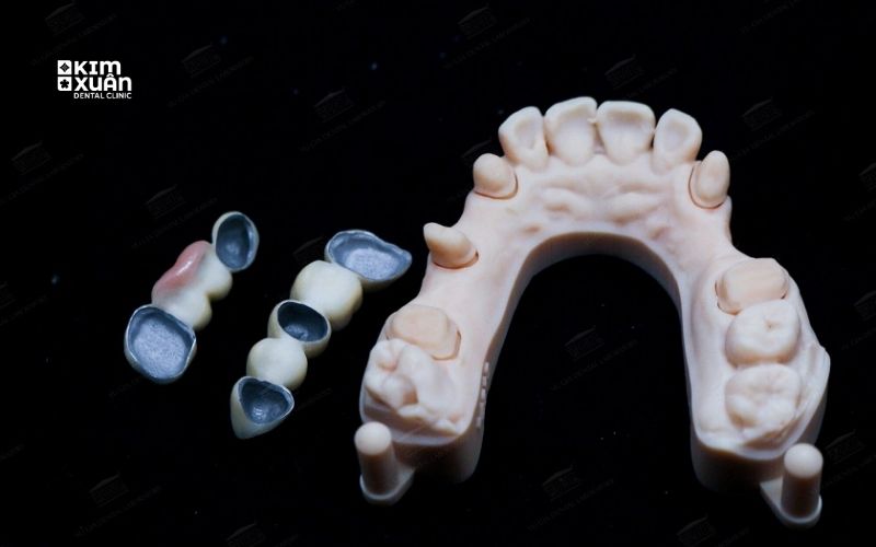 Răng Sứ Titan Có Bền Không