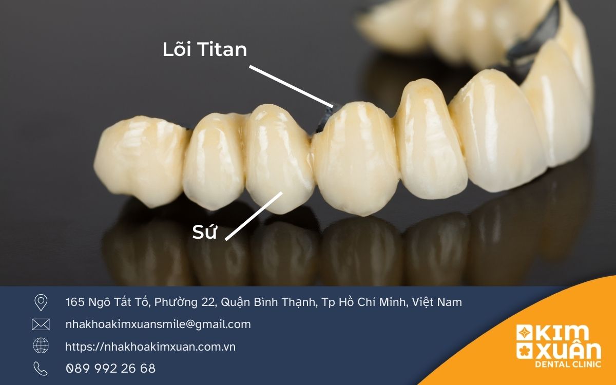 Răng Sứ Titan