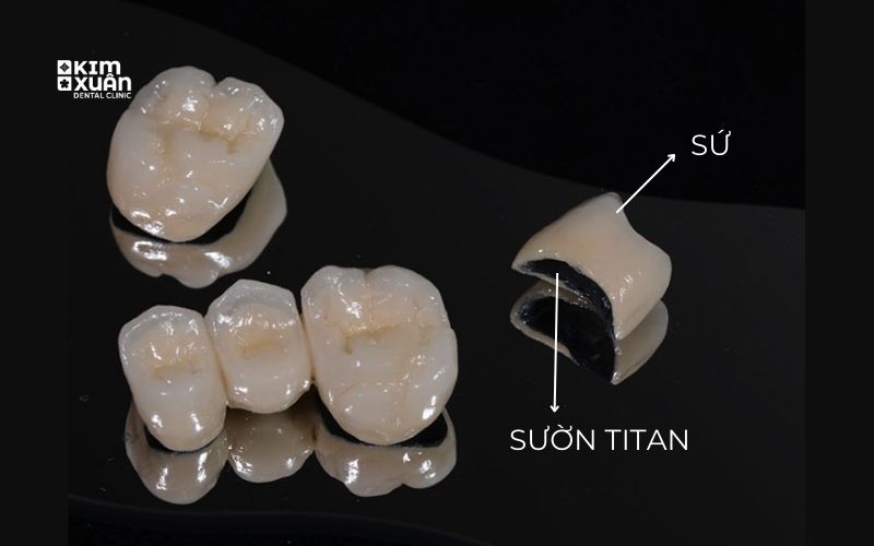Răng Sứ Titan