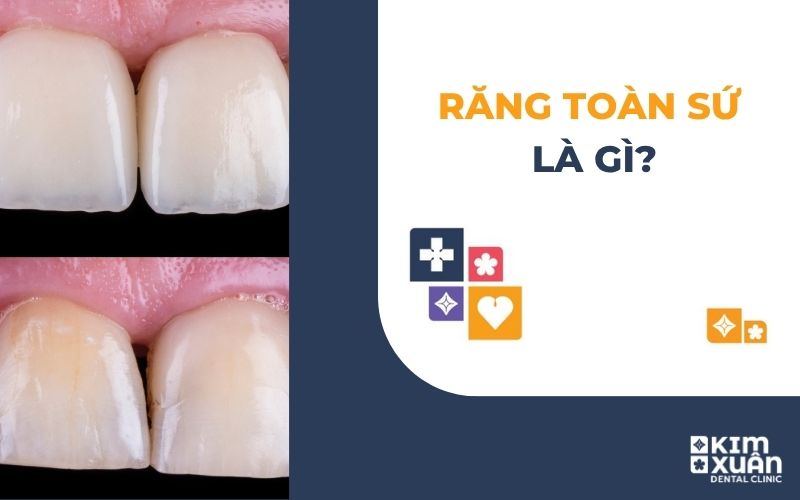 Răng Sứ Toàn Sứ Là Gì