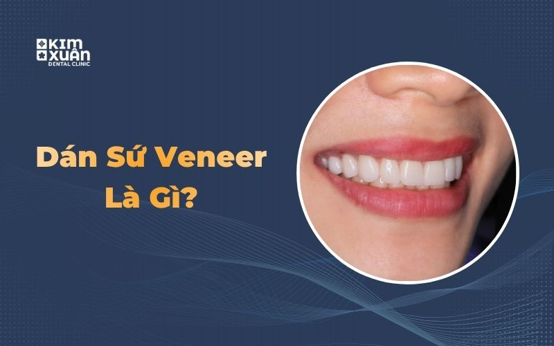 Răng sứ veneer