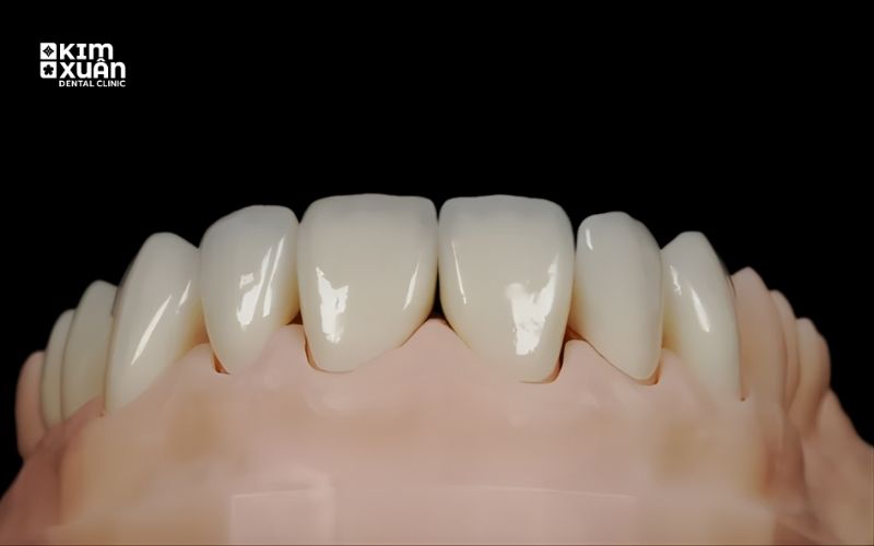 Răng Sứ Zirconia Có Mấy Loại