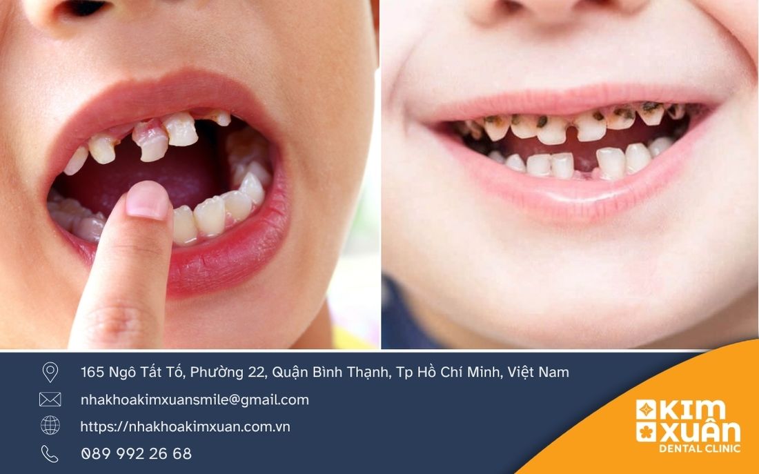 Răng Sữa Bị Sâu Có Nên Nhổ Hay Không?