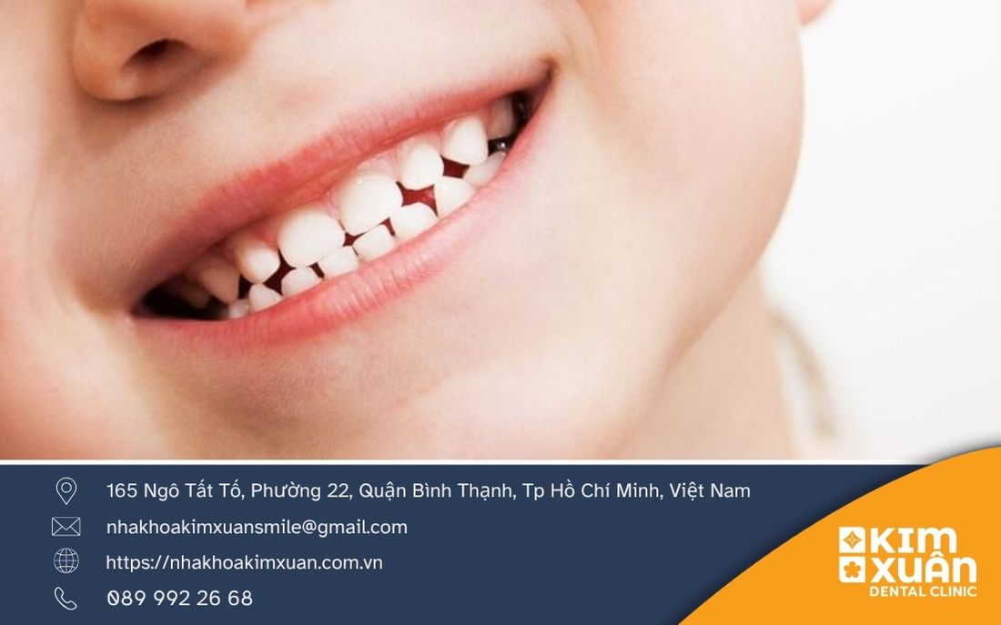 Răng Sữa Là Gì Có Quan Trọng Không?