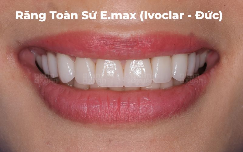 Răng Toàn Sứ Emax