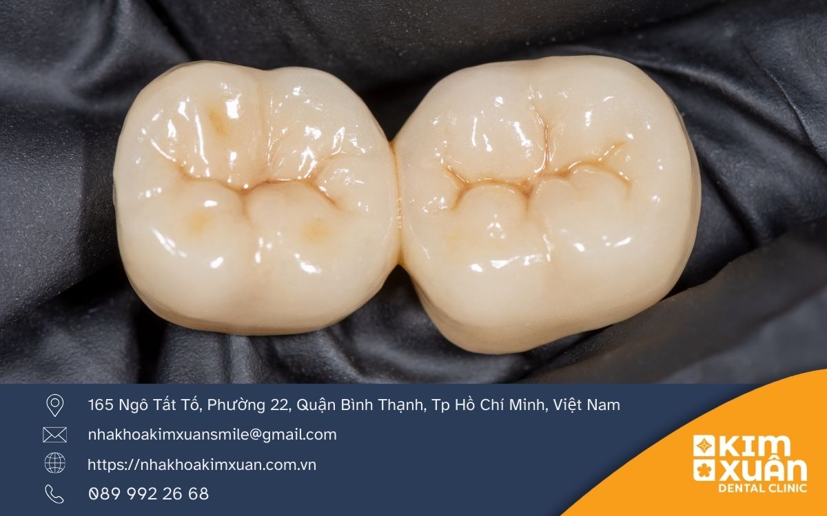 Răng Toàn Sứ Giá Bao Nhiêu