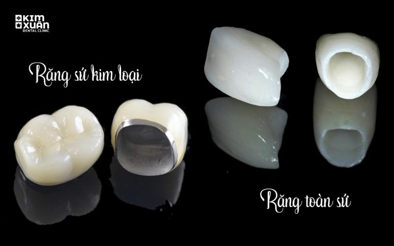 Răng Toàn Sứ Và Răng Sứ Kim Loại