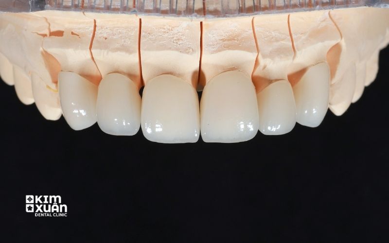 Răng Toàn Sứ Zirconia