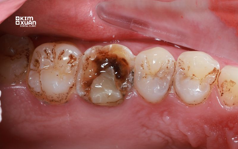 Răng trám bị bung bể có nguy hiểm không