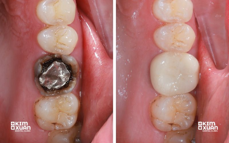 Răng trám bị bung bể có trám được không