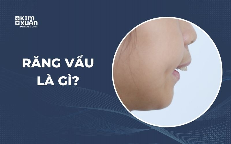 Răng Vẩu Là Gì