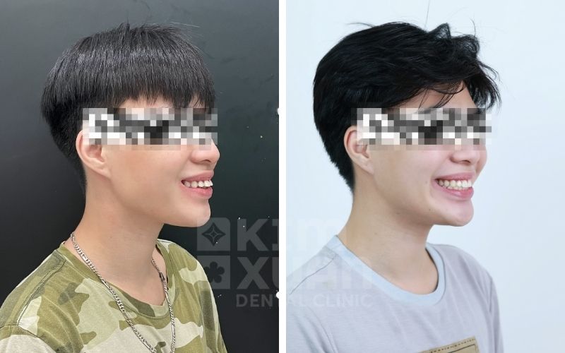 Răng Vẩu Trước Và Sau Khi Niềng Tại Nha Khoa Kim Xuân