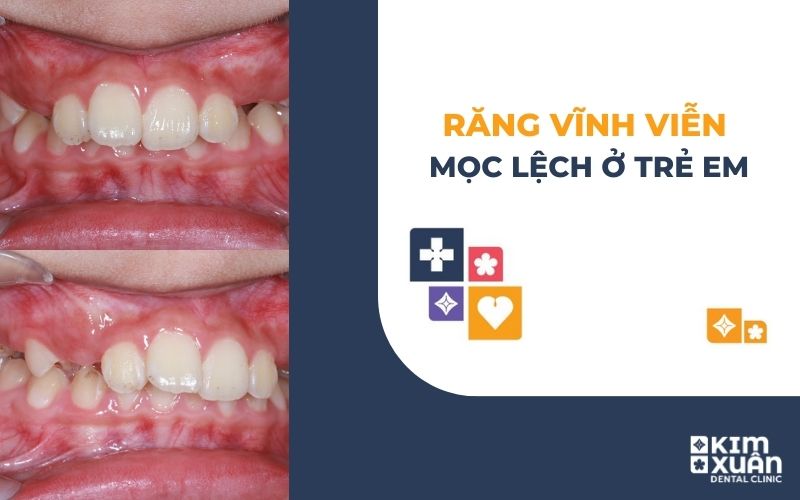 Răng Vĩnh Viễn Mọc Lệch Ở Trẻ Em