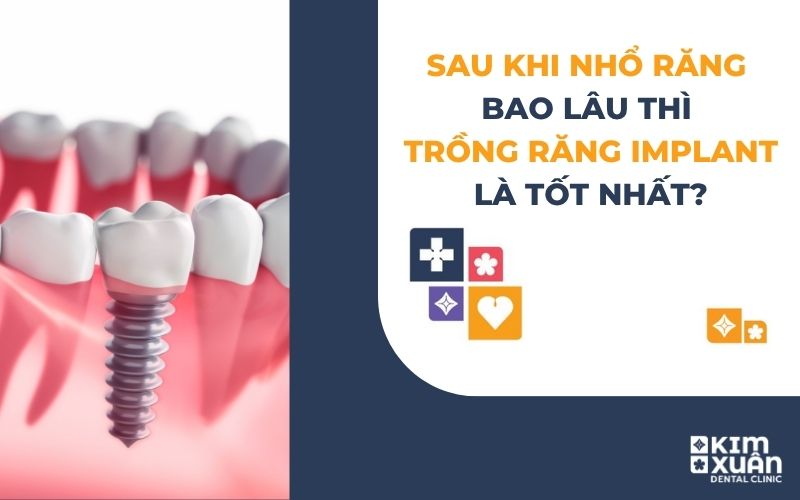 Sau Khi Nhổ Răng Bao Lâu Thì Trồng Răng