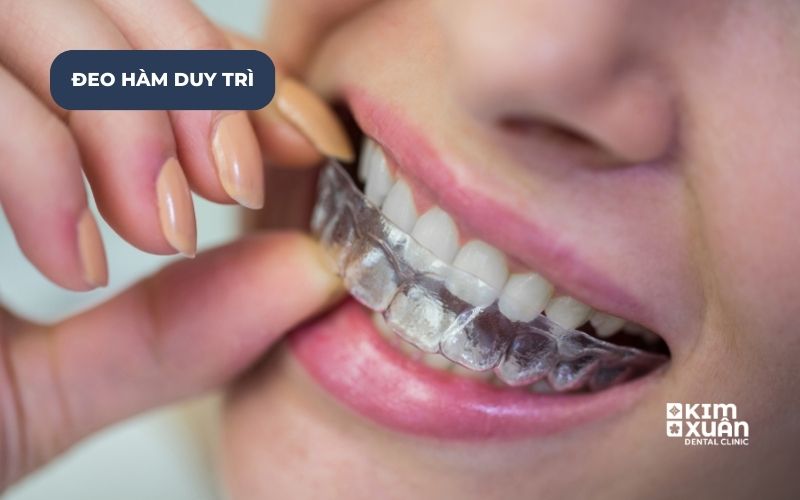 Sau Khi Tháo Niềng Đeo Máng Duy Trì