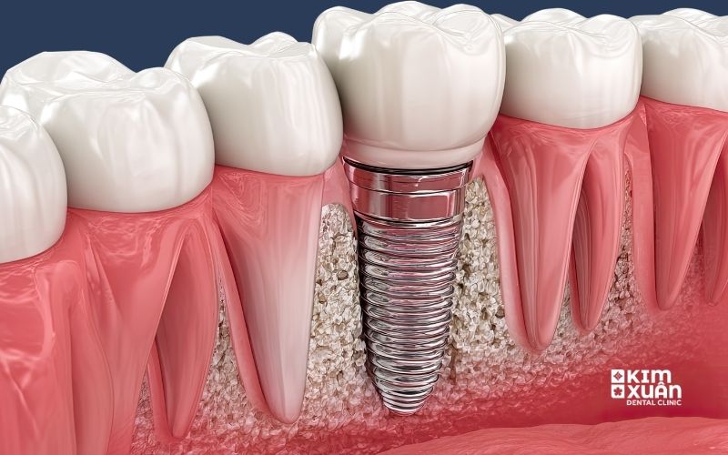Sau Khi Trồng Răng Implant Có Biểu Hiện Gì