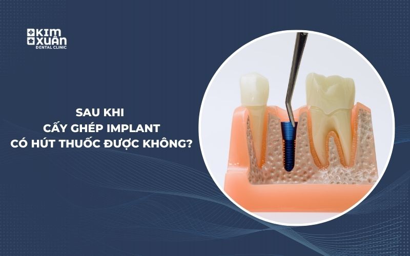 Sau Khi Trồng Răng Implant Có Hút Thuốc Được Không
